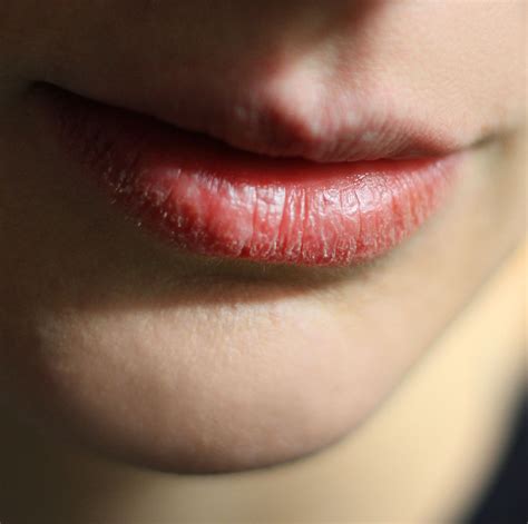 can kissing make your lips chapped all over