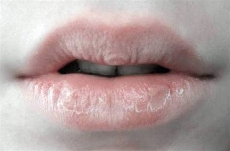 can kissing make your lips dry raw