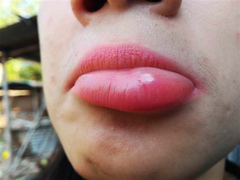 can kissing make your lips swollen inside nose