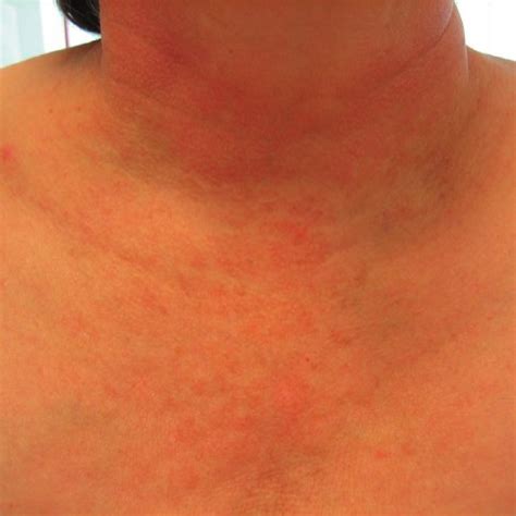 can levothyroxine cause a rash? - Thyroid cancer - Inspire