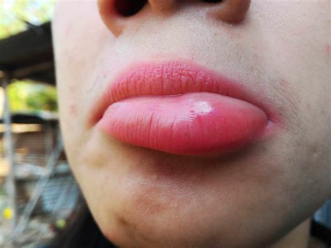 can lips get swollen after making out women