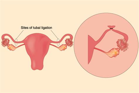 can ur tubes come untied