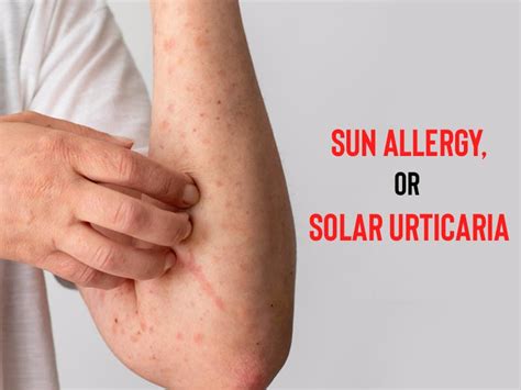 can you develop sun allergy