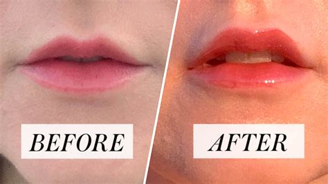 can you kiss after lip filler