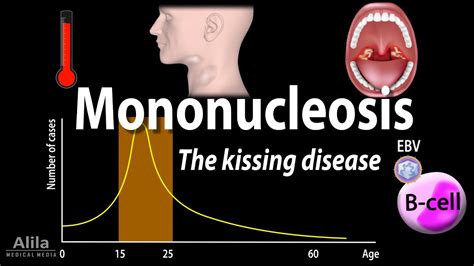 can you kiss someone after having mono