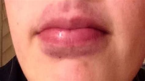 can your lips burn from kissing face image