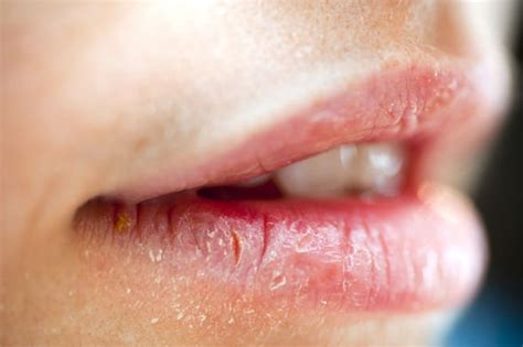 can your lips get thinner coronavirus causes