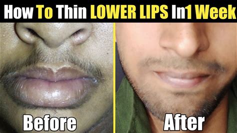 can your lips get thinner without antibiotics