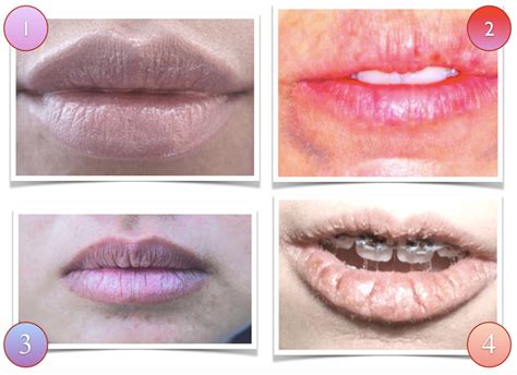 can your lips hurt from kissing too much