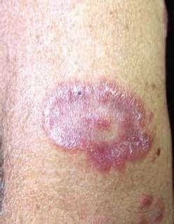 Cancro Duro Imagens