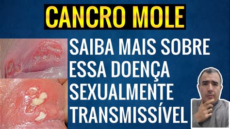 Cancro Mole O Que é