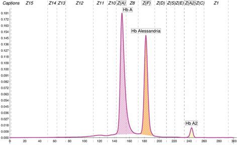 Read Capillarys Hemoglobin E Using The Capillarys 2 Flex 