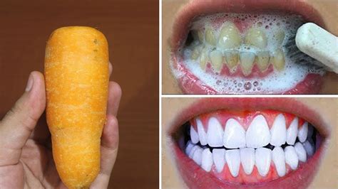 cara menghilangkan gigi kuning