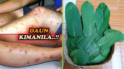 cara mengobati penyakit kulit dengan daun ketepeng