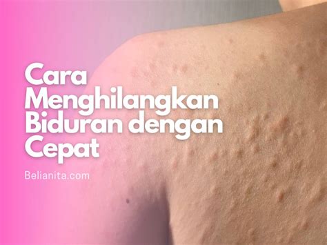 Cara Mudah Menghilangkan Biduran dalam Sekejap