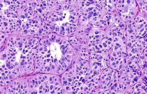Carcinoid Syndrome Histology