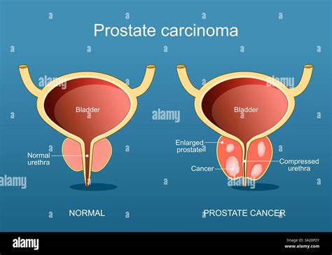 Carcinoma Of Prostate