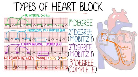 Cardiac Heart Blocks