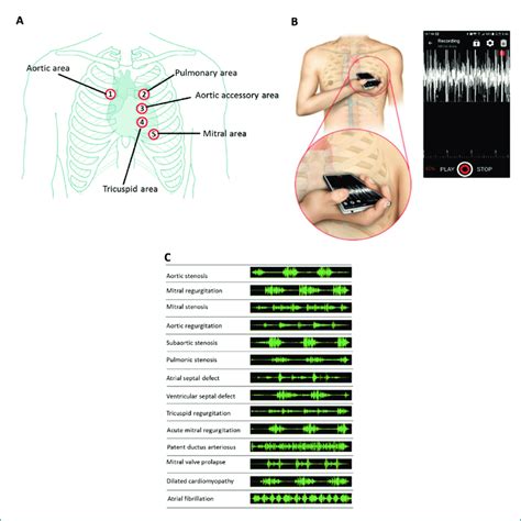 Cardiac Microphone