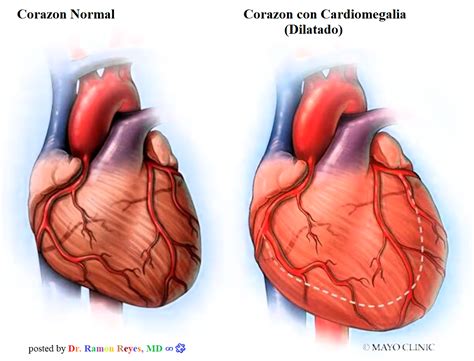 cardiomegalia