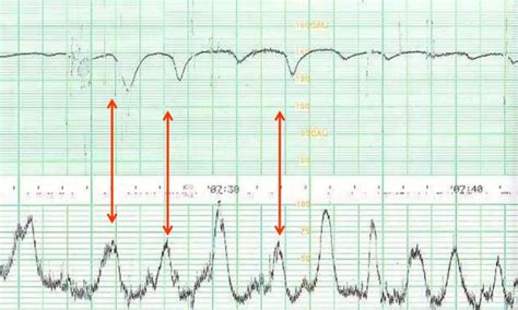 Cardiotocografia