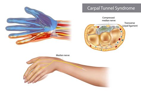 carpaal tunnel