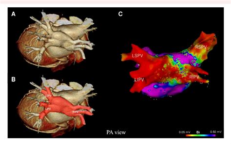 case report of paroxysmal atrial fibrillation in three pulmonary veins ...