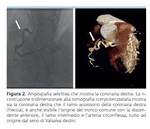 Read Online Caso Clinico Origine Anomala Della Coronaria Destra Dal 