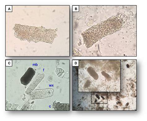 casts in the urine sediment 2ndchance info