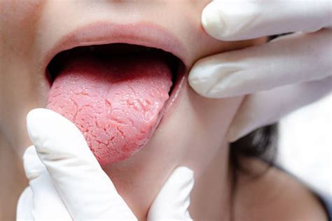 cause tagli sulla lingua