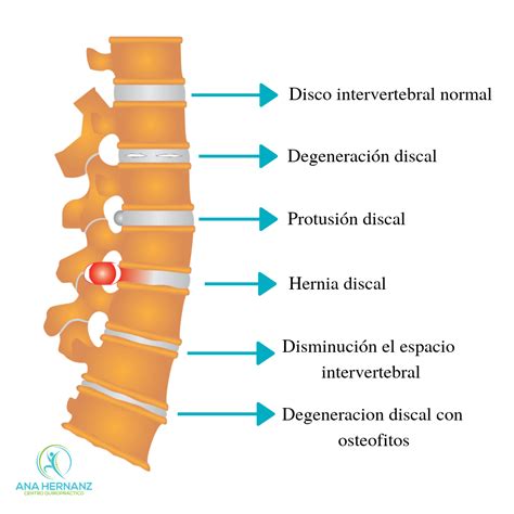 cbd hernia discal