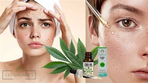 cbd y acne