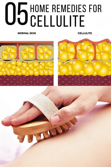 Cellulite Cure