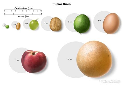 Centimeters Tumor Size Chart