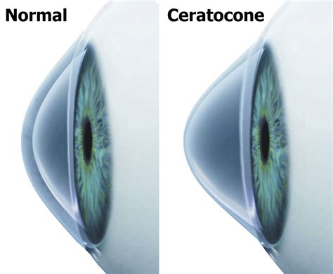 ceratocone sintomas