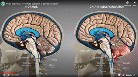 Cerebellar Tonsillar Ectopia