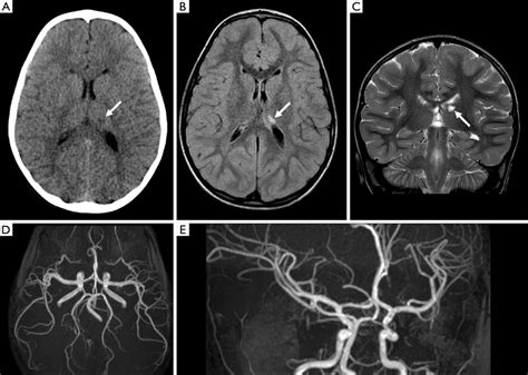 Read Online Cerebral Angiography Normal Anatomy And Vascular Pathology 