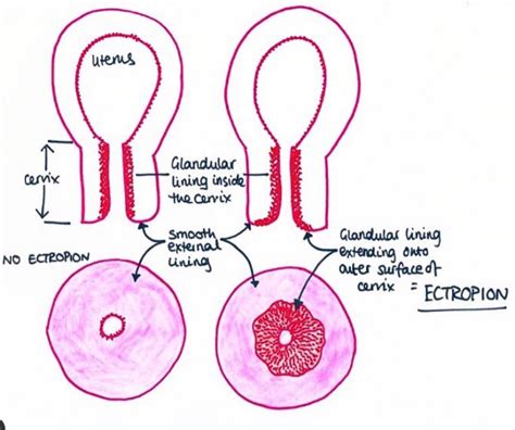 Cervical Ectropion Erosion
