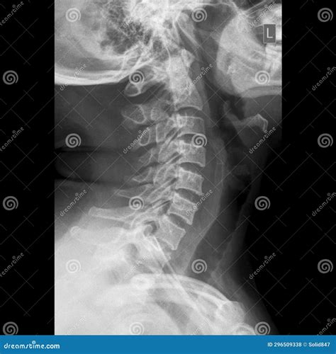 Cervical Spine Lateral View