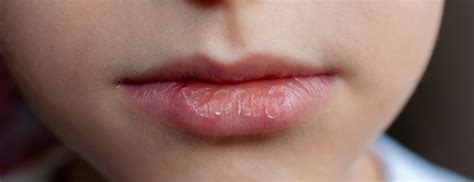 chapped lips after kissing