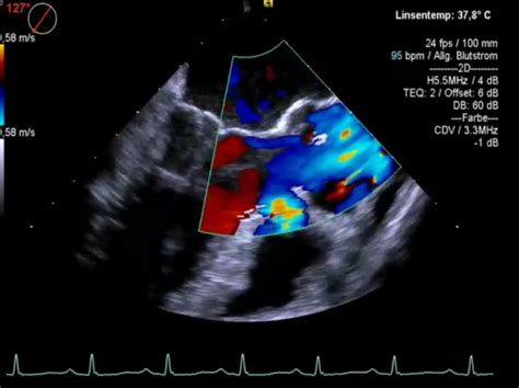 Chapter 15 Endocarditis 123 Sonography