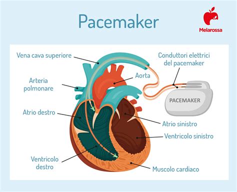 che cos è pacemaker