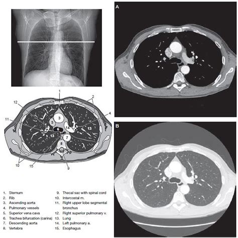 Chest Ct Scan With Contrast