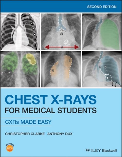 Chest X Rays Made Easy