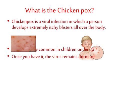 Chicken Pox Ppt
