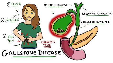 Choledocholithiasis Vs Cholecystitis