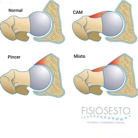 choque femoroacetabular