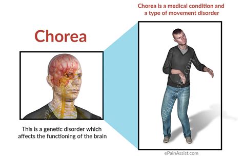 Chorea Movement Disorder