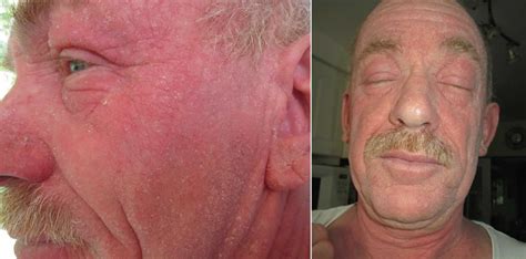 Chronic Actinic Dermatitis