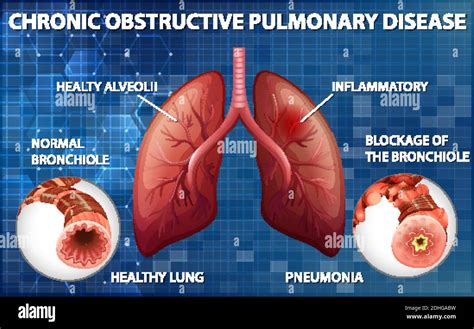 chronic obstructive pulmonary disease
